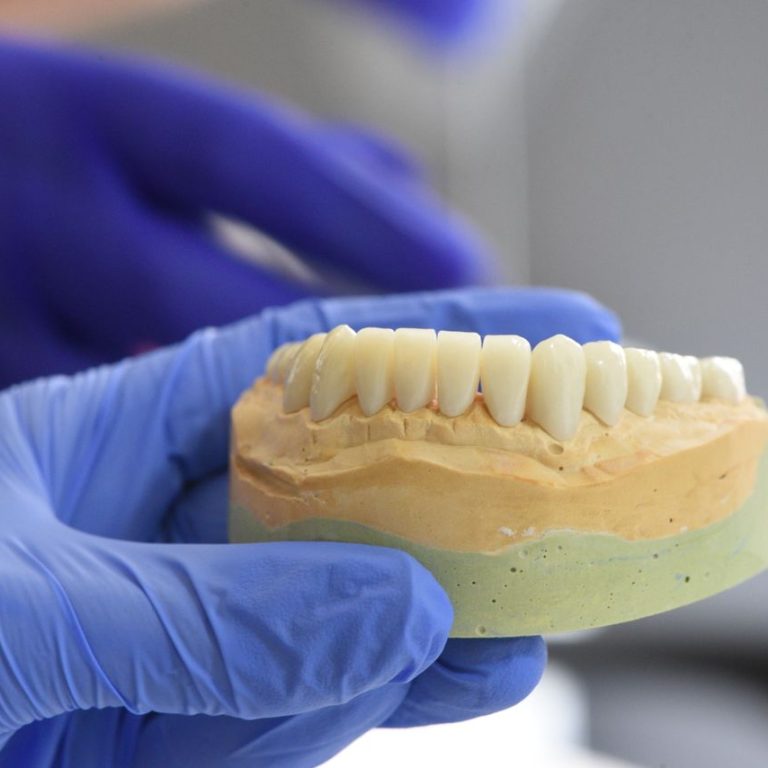 Dental Implants