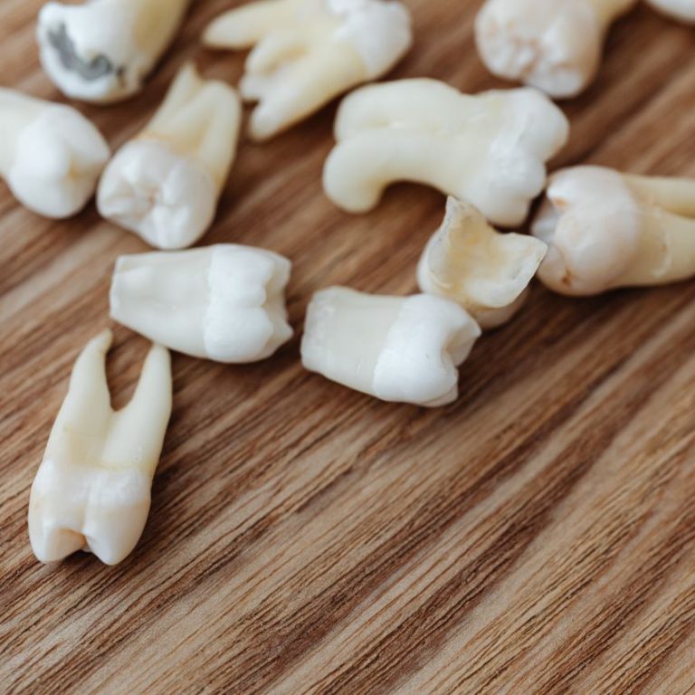 Wisdom Teeth